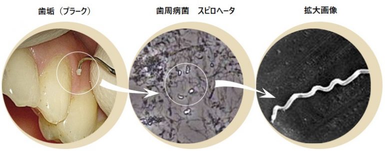 歯垢(プラーク)