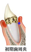 歯周病の流れ